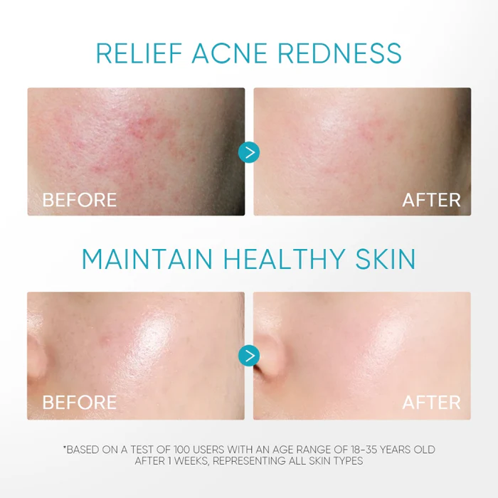 SKINTIFIC 5% Panthenol Acne Calming Water Gel 45g - Image 4