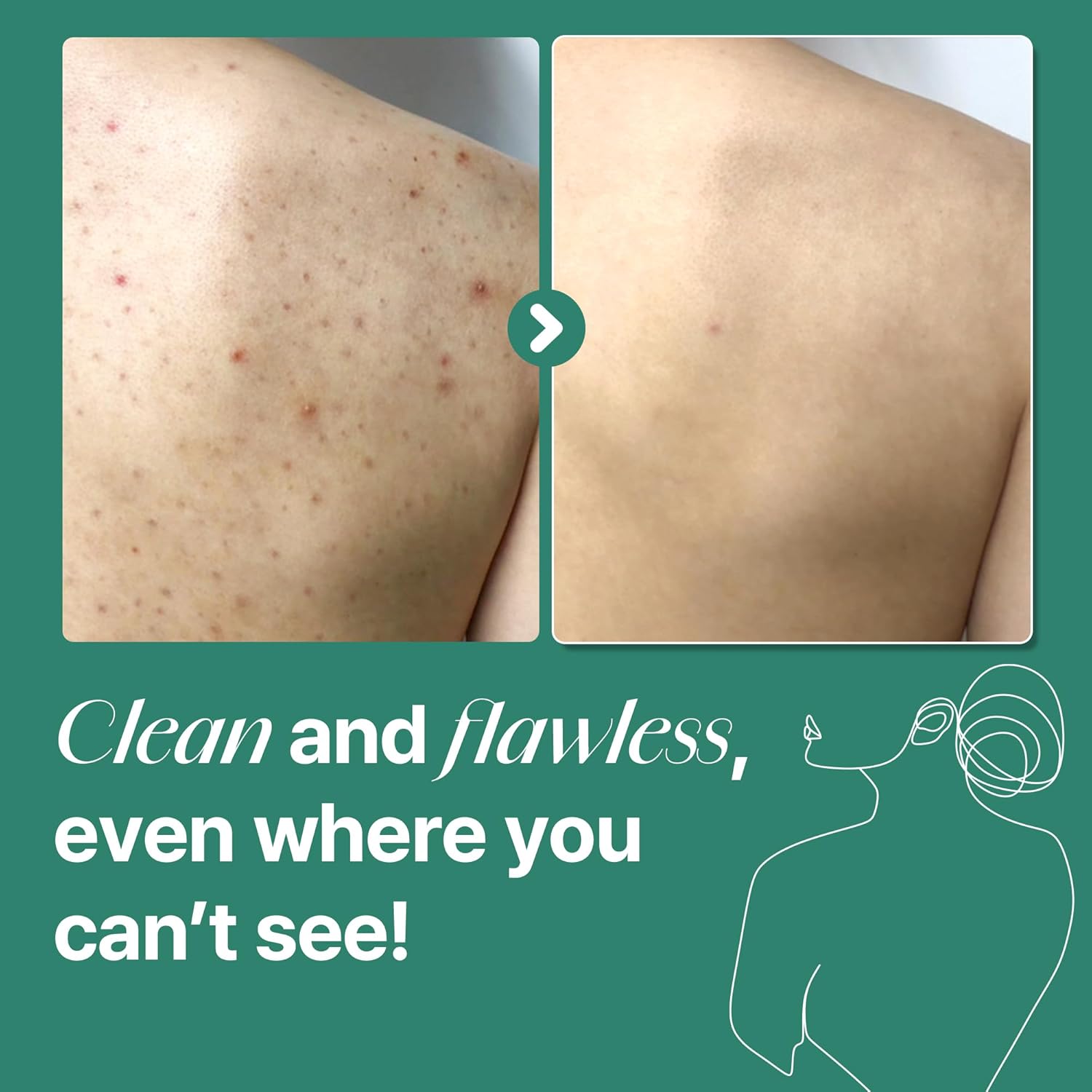 SOME BY MI AHA BHA PHA 30 Days Miracle Pimple Clear Body Cleanser 400g - Image 4